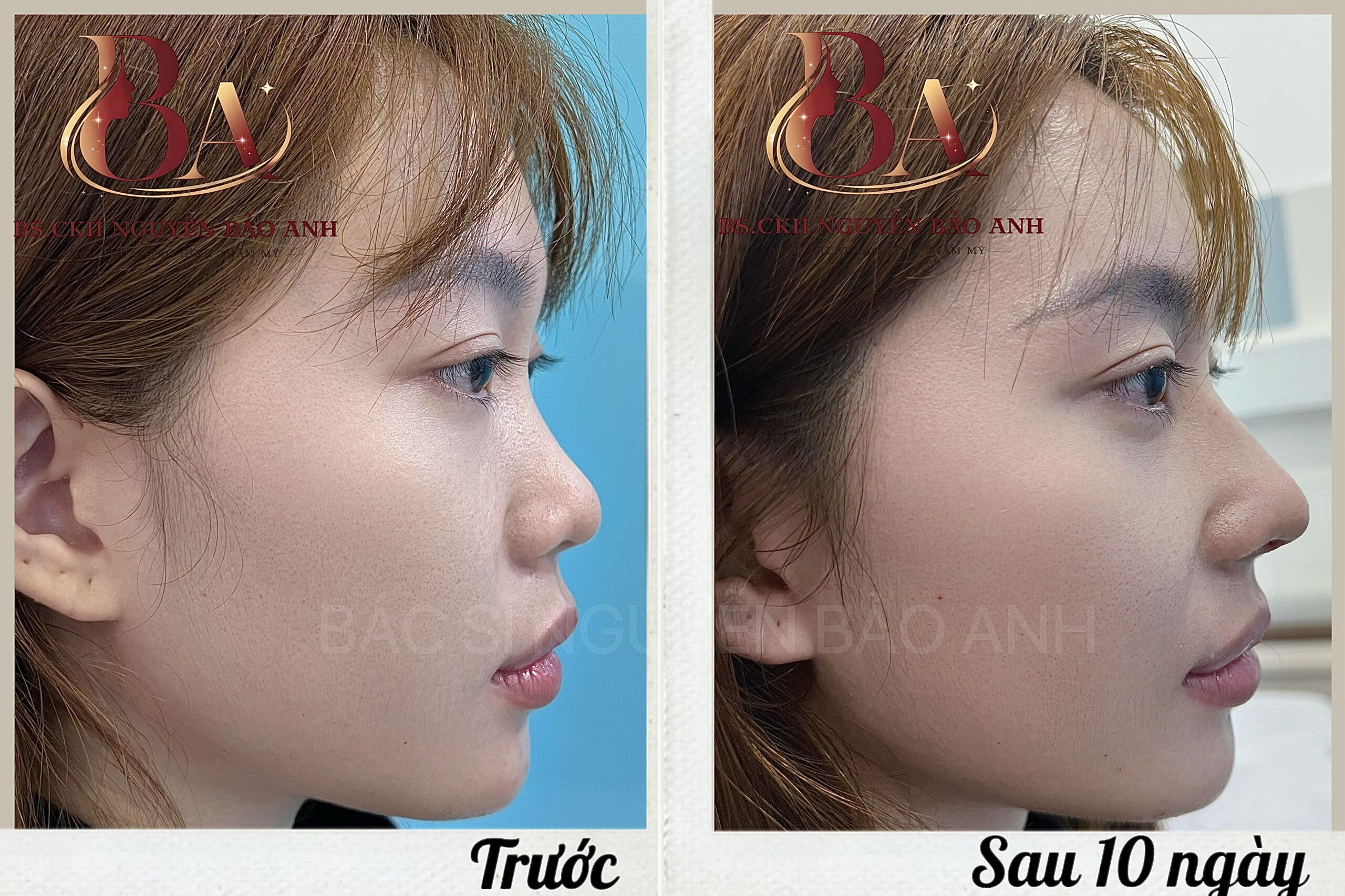 Kết quả nâng mũi cấu trúc sau 10 ngày cắt chỉ - Bác sĩ Nguyễn Bảo Anh