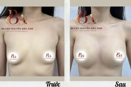 Nâng Ngực (Nâng Vòng 1) Là Gì? Những Điều Cần Biết Trước Khi Làm