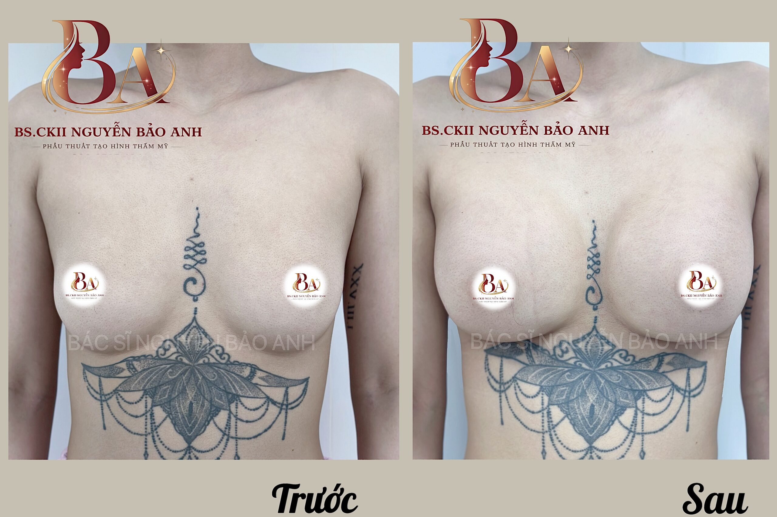 Hình ảnh trước và sau khi nâng ngực bảo tồn thực hiện bởi BS.CKII Nguyễn Bảo Anh