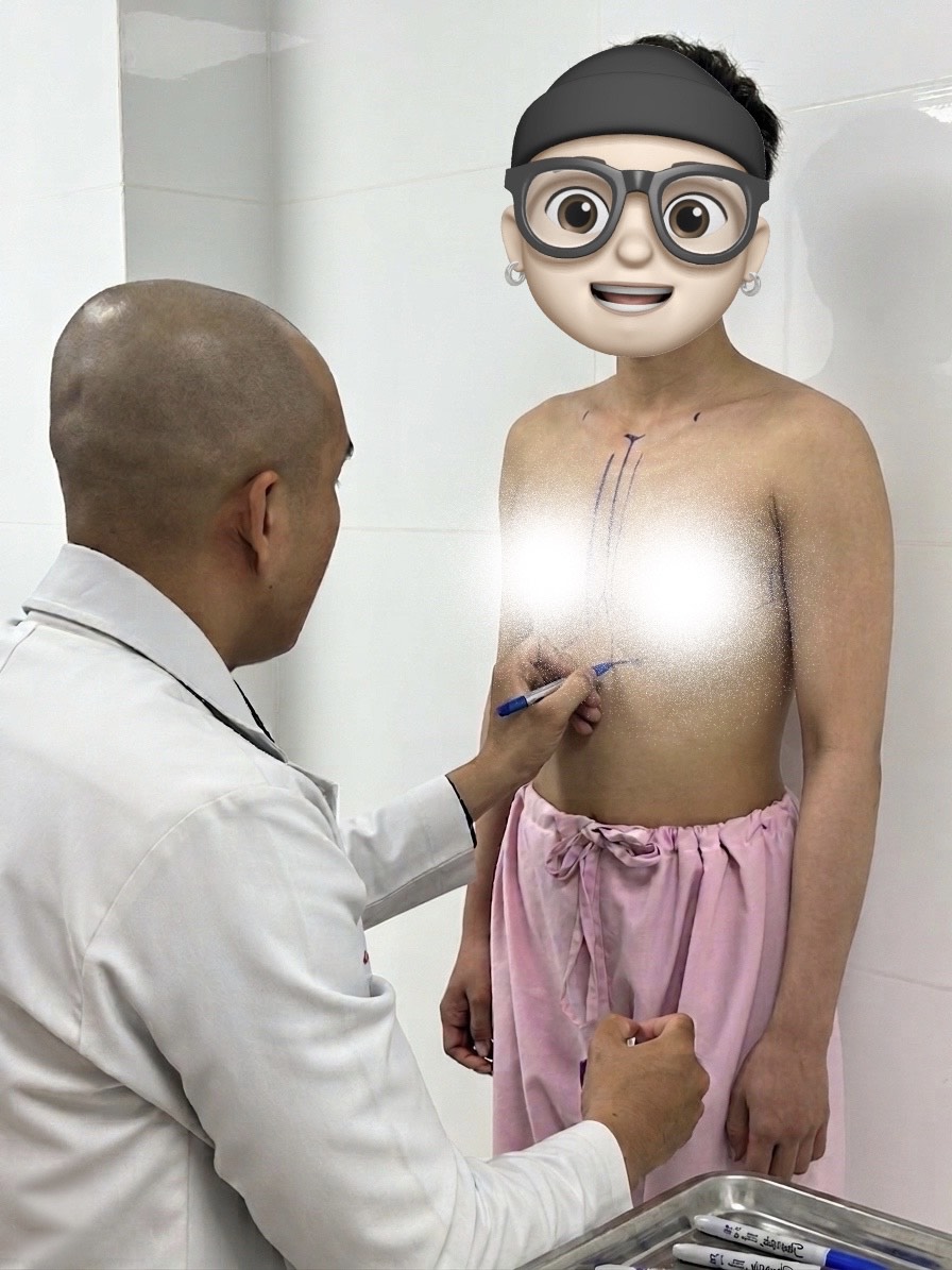 Bác sĩ Nguyễn Bảo Anh đo vẽ thiết kế đường mổ trước phẫu thuật thu gọn tuyến vú phì đại.