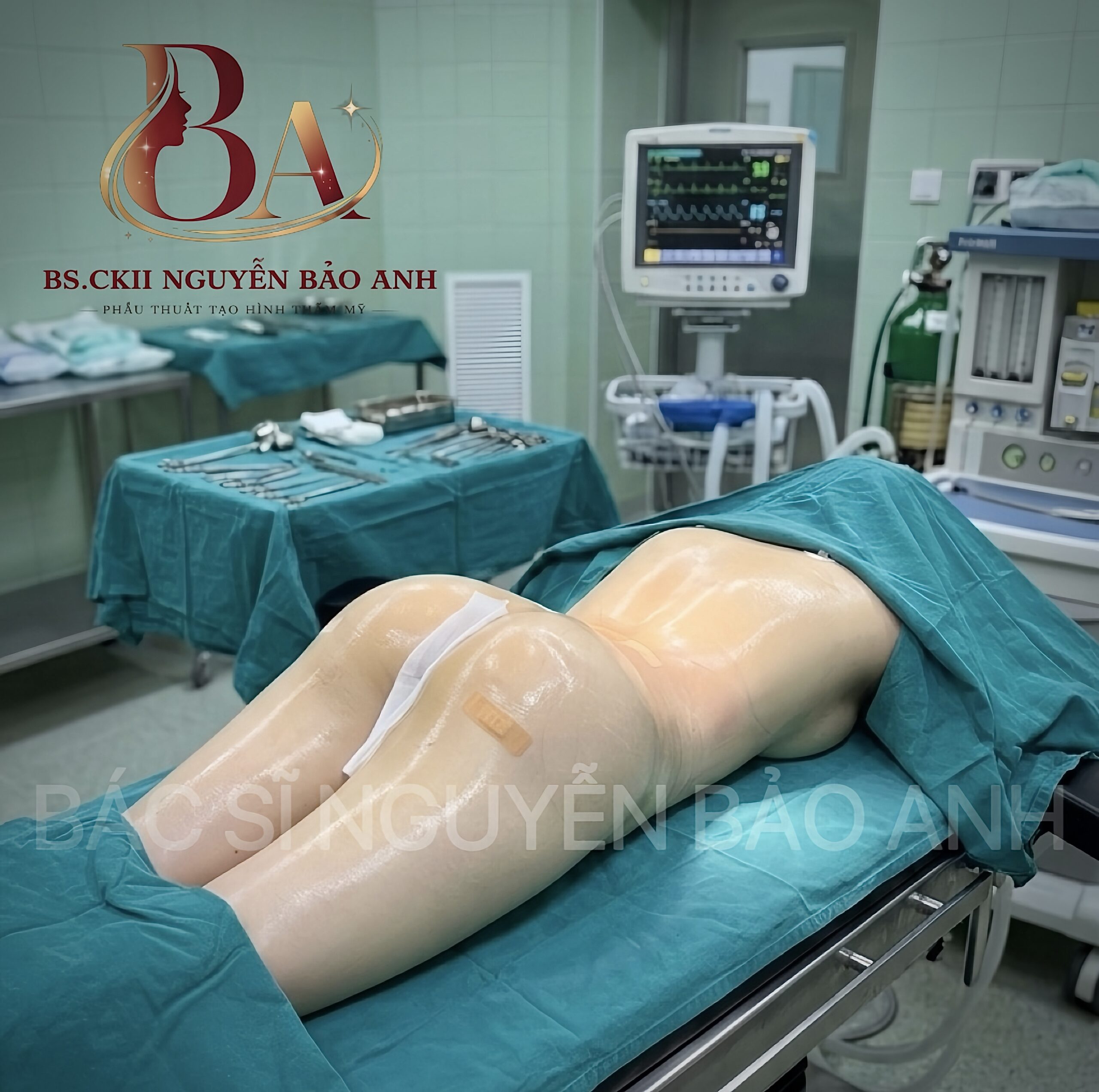 Hình ảnh thực tế một ca phẫu thuật nâng mông, độn mông an toàn trực tiếp thực hiện bởi Bs Bảo Anh.