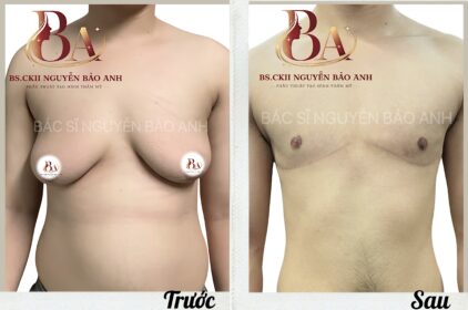 Phẫu thuật cắt ngực, thu gọn vú phì đại