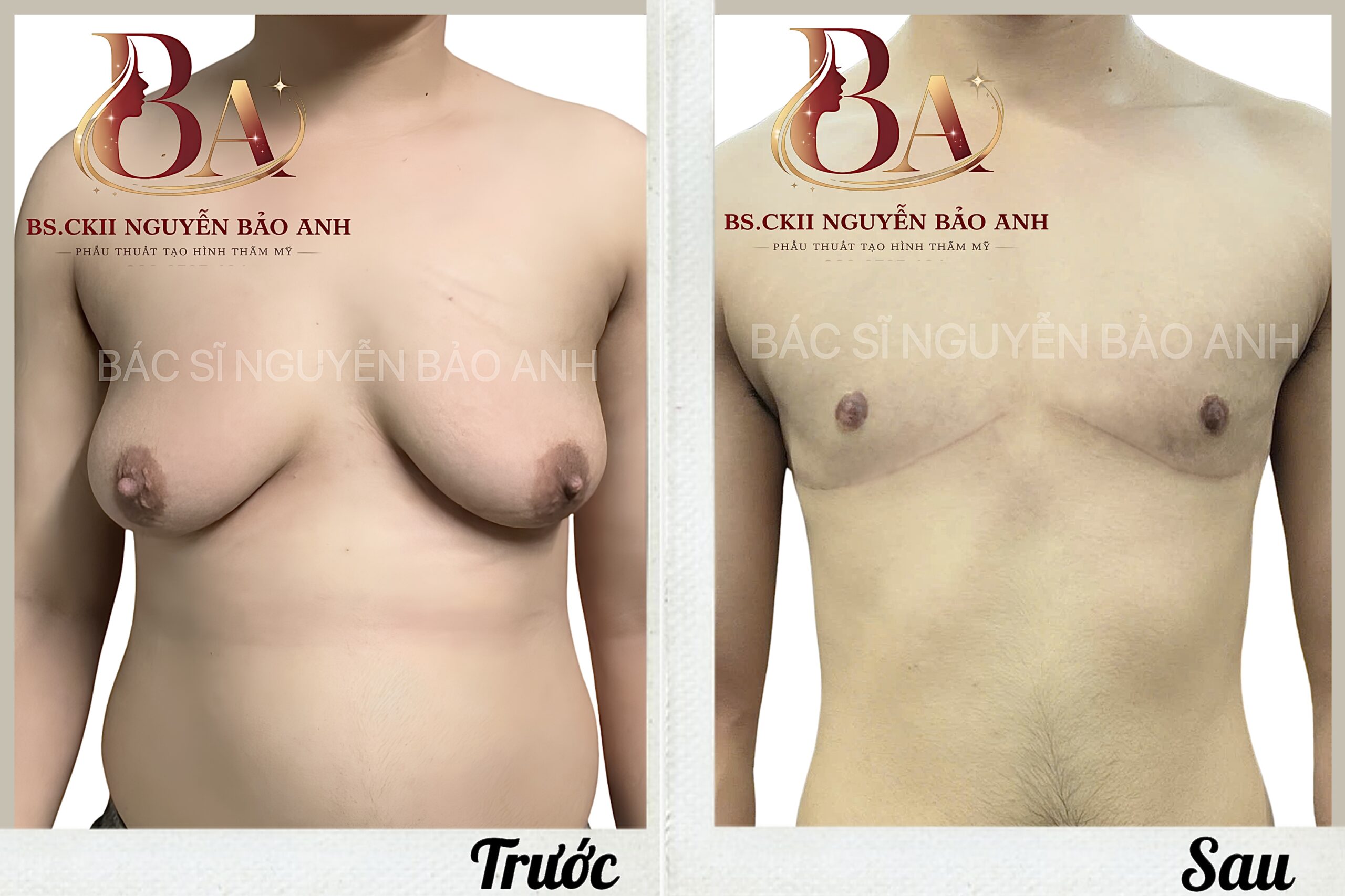 Kết quả trước và sau phẫu thuật thu gọn tuyến vú phì đại thực hiện bởi Bác sĩ Nguyễn Bảo Anh.