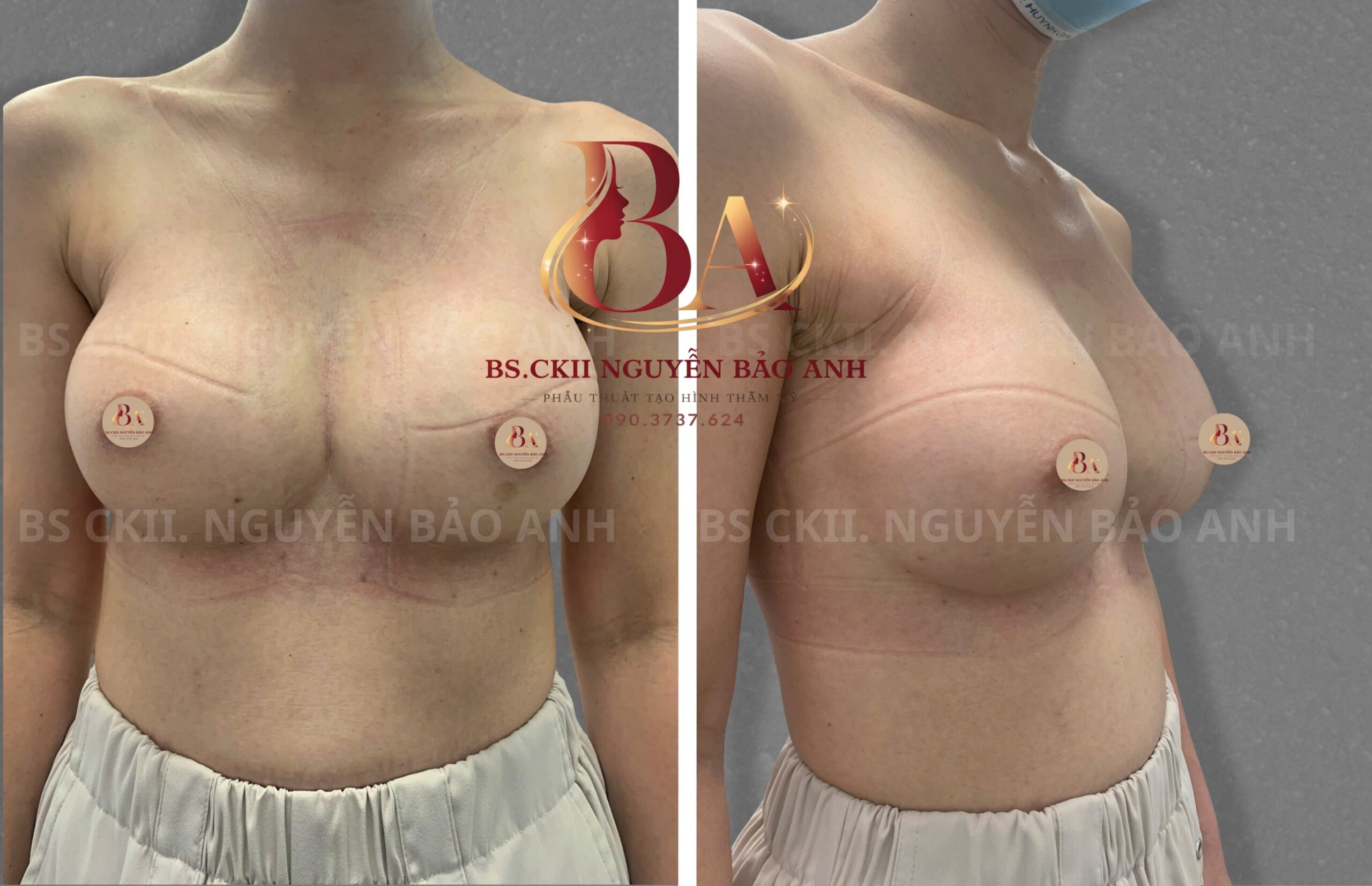 Hình ảnh khách hàng sau nâng ngực nội soi đường nách do BS Bảo Anh thực hiện