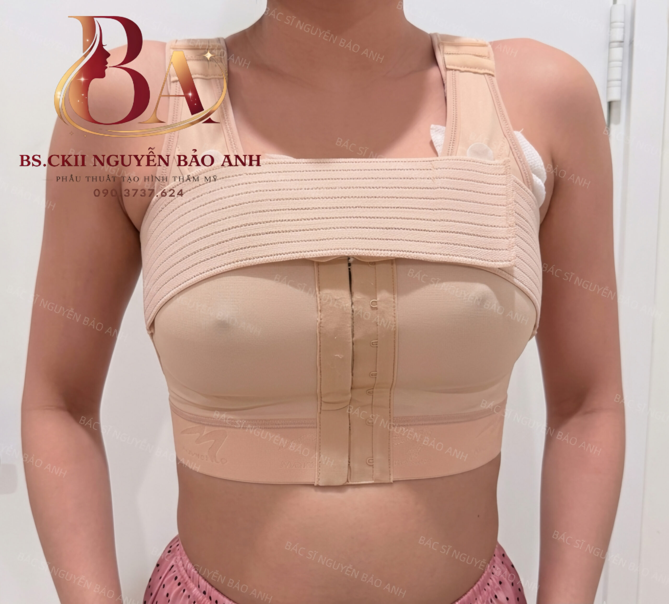 Áo định hình chuyên dụng sau phẫu thuật nâng ngực cùng BS Bảo Anh