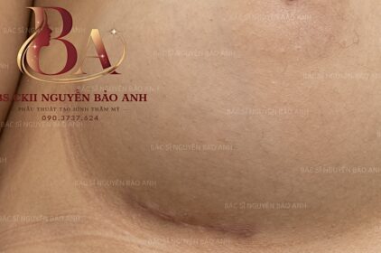 5 Nội Dung Phòng Ngừa Sẹo Nâng Ngực Quan Trọng | BS Bảo Anh