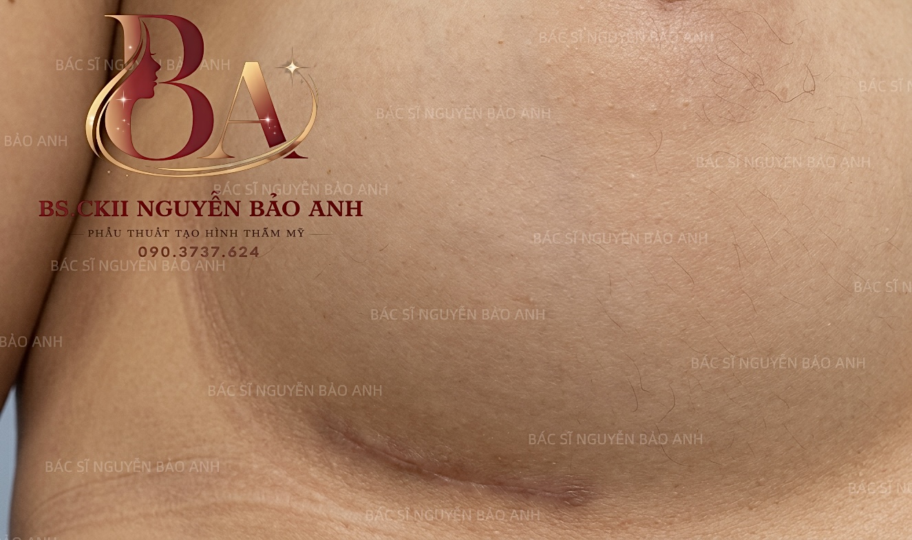 Chăm sóc phòng ngừa sẹo sau phẫu thuật nâng ngực cùng BS Bảo Anh